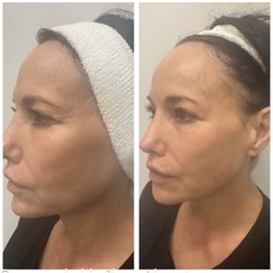 Xerf Before and after only 1 treatment