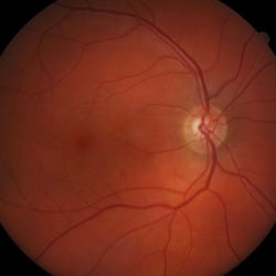 Solano Eye Care - We can take photos of your retina to ensure eye health.