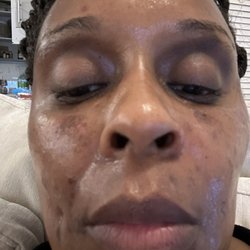 Ibeauty Med Spa - Blistering after chemical peel service