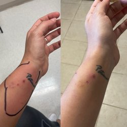 MedPost Urgent Care of Rowlett - Day 1 cat bite, marked at clinic vs Day 3 on antibiotics.