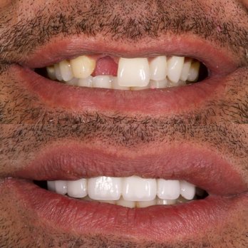One Stop Implants - Beautiful Porcelain Veneers - Cosmetic Dentists Near Me - Norwalk, California One Stop Implants - Beautiful Porcelain Veneers - Cosmetic Dentists Near Me - Norwalk, California