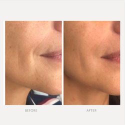 Elite Skin and Beauty - Soften expression lines with Restylane for natural looking results by master injector Kathy Corbo
