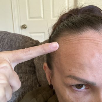 LaserAway - Tell me why this has been there since the last time I got Botox it never went away that should not happen. - Medical Spas Near Me - Folsom, California