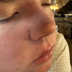 Foothills Med Spa - Cleaned from extractions