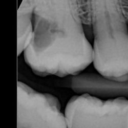 Park Slope Family Dentistry, PC - Massive decay in 2024, visible in 2021. No xrays in between. Too late to save most likely!