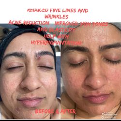 Skin Care & Threading By Neeru - Before & After Hydro Facial all the blackheads out