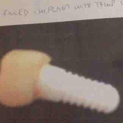 Neal Lehrman, DDS, MS - Laser Periodontal - My failed implant with temporary crown still attached