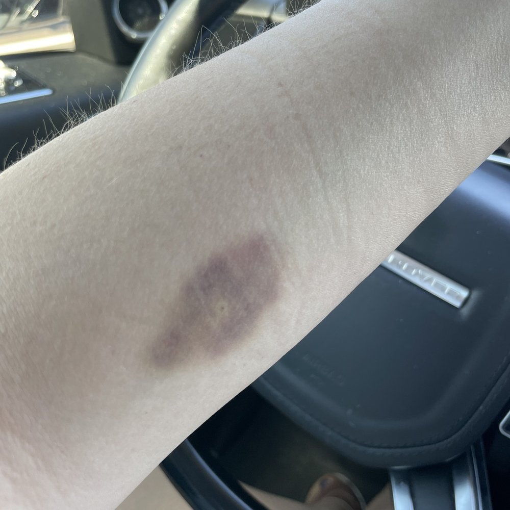 Sonora Quest Laboratories - Bruise from a simple blood draw - Laboratory Testing Near Me - Scottsdale, Arizona