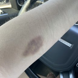 Bruise from a simple blood draw Bruise from a simple blood draw