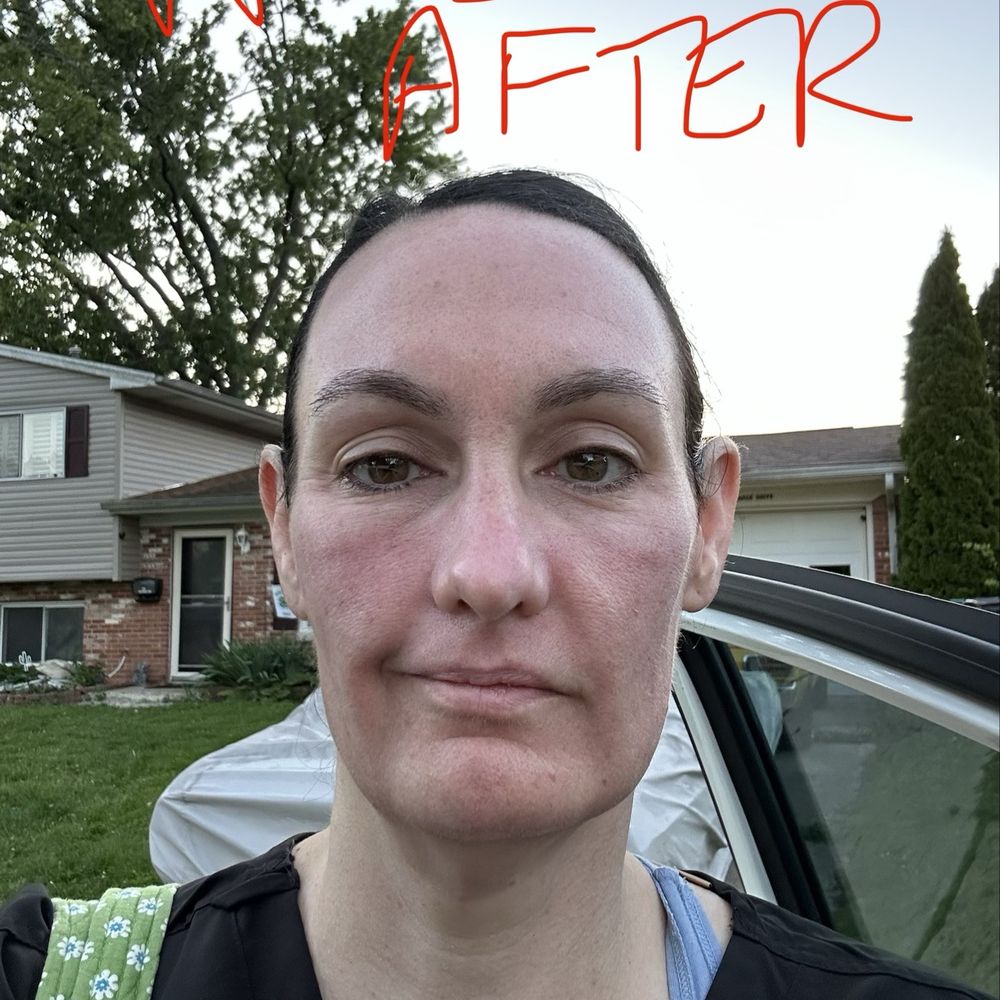 Turkle & Associates - Day after first treatment - Cosmetic Surgeons Near Me - Carmel, Indiana