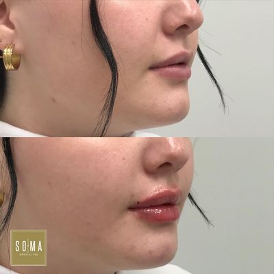 Lips lips lips! - Non-surgical lip augmentation by Julieta Moran MD and Aida Mahfood MMS, PA-C. Lips lips lips! - Non-surgical lip augmentation by Julieta Moran MD and Aida Mahfood MMS, PA-C.
