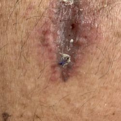 A to Z Dermatology - Those are the internal stitches coming out!  Other pictures show how it started and what we are left with. Total disgrace.