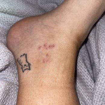 Nail Tech - 2nd foot she touched before I asked her to stop again and she listened. Scabbed over. Picture from today. (2 days after appointment) - Nail Salons Near Me - Saint Joseph, Michigan Nail Tech - 2nd foot she touched before I asked her to stop again and she listened. Scabbed over. Picture from today. (2 days after appointment) - Nail Salons Near Me - Saint Joseph, Michigan