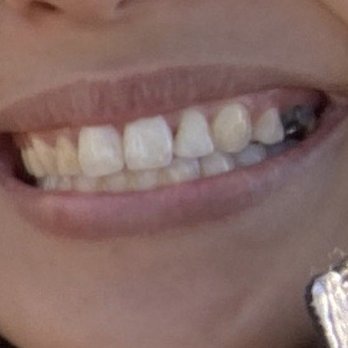 Joseph Elmassian, DDS - Before- root canal, no crown - General Dentistry Near Me - Pasadena, California Joseph Elmassian, DDS - Before- root canal, no crown - General Dentistry Near Me - Pasadena, California