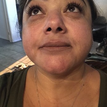 Lucent Cosmetics - Morning after injections - Medical Spas Near Me - Glendora, California