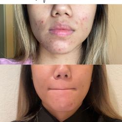 Newport Acne Clinic