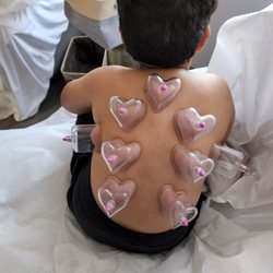 Lindsay Trottier, DACM LAC - Level Acupuncture - Cupping for my son