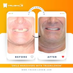TruSmile Now
