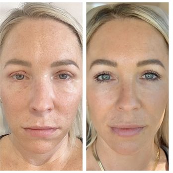 Capri Aesthetics - Microneedling before & after - Estheticians Near Me - Needham, Massachusetts