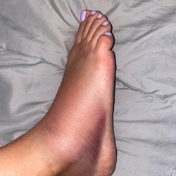Acupuncture Global Systems - This photo is before acupuncture and the blood release.
