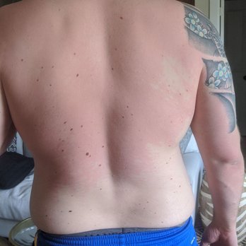Trifecta - Red rash all over trunk, front and back. Also, rash all over arms and legs, not pictured hered. - Food Delivery Services Near Me - Sacramento, California Trifecta - Red rash all over trunk, front and back. Also, rash all over arms and legs, not pictured hered. - Food Delivery Services Near Me - Sacramento, California