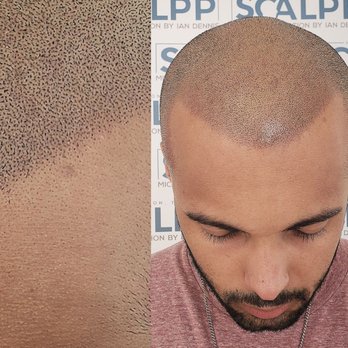 Scalp Hair Pigmentation Houston Texas Zoomed In Hairloss Solution