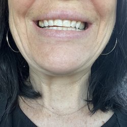 Michael Mostofi, DDS - Laguna Niguel - I immediately after one treatment. Apparently it will get wider over the next few days!!!