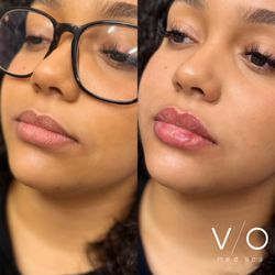 VIO Med Spa  - Lip filler before and after