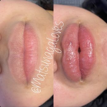 Matsunaga Loves - Body Contouring Near Me - Milpitas, California Matsunaga Loves - Body Contouring Near Me - Milpitas, California