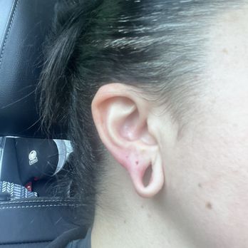 MidAmerica Plastic Surgery - Stretched earlobes before procedure - Cosmetic Surgeons Near Me - Glen Carbon, Illinois MidAmerica Plastic Surgery - Stretched earlobes before procedure - Cosmetic Surgeons Near Me - Glen Carbon, Illinois