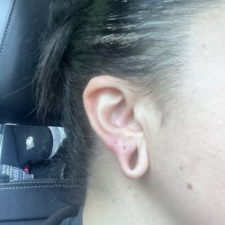 MidAmerica Plastic Surgery - Stretched earlobes before procedure