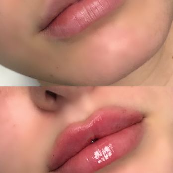 CJ Laser - Lip fillers by "NYC injector"! - Laser Hair Removal Near Me - Brooklyn, New York