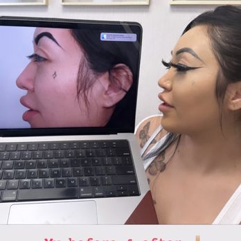 Vladimir Grigoryants, MD - Before and after rhinoplasty - Cosmetic Surgeons Near Me - Glendale, California Vladimir Grigoryants, MD - Before and after rhinoplasty - Cosmetic Surgeons Near Me - Glendale, California