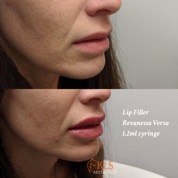 KLS Aesthetics - Lip Filer with Jen Corona, RN - Skin Care Near Me - Renton, Washington KLS Aesthetics - Lip Filer with Jen Corona, RN - Skin Care Near Me - Renton, Washington