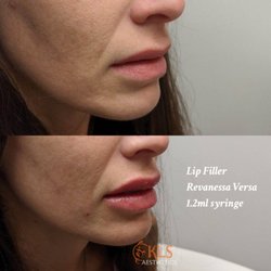 Lip Filer with Jen Corona, RN