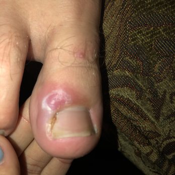 Lily Nails at OSU  - Hangnail clipped from pedicure - Nail Salons Near Me - Columbus, Ohio