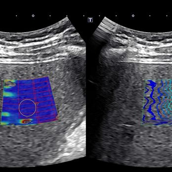 Advanced Radiology - Ultrasound Marketing Image - US Elastography, Liver - Radiologists Near Me - Columbia, Missouri