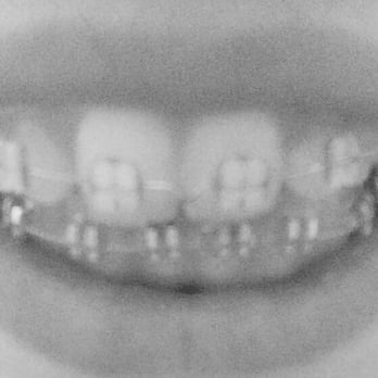 McCranels Orthodontics - after (3 months in hello bottom teeth I never see when I bite down ) finally :) some progress photo so you can see their work - Orthodontists Near Me - West Palm Beach, Florida McCranels Orthodontics - after (3 months in hello bottom teeth I never see when I bite down ) finally :) some progress photo so you can see their work - Orthodontists Near Me - West Palm Beach, Florida