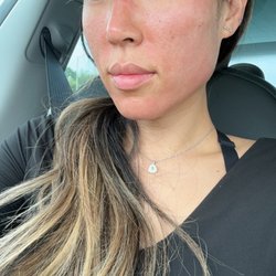Aevum Aesthethics - Right after vampire facial