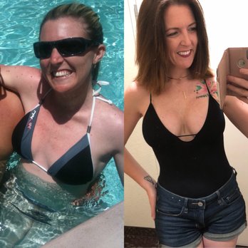 Dr K Plastic Surgery Orange County - Before and after. 34B to 34DDD! - Cosmetic Surgeons Near Me - Irvine, California Dr K Plastic Surgery Orange County - Before and after. 34B to 34DDD! - Cosmetic Surgeons Near Me - Irvine, California