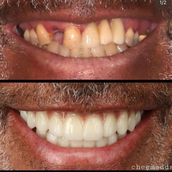 Lakeside Dental - Full mouth Fixed Implant teeth - General Dentistry Near Me - Folsom, California Lakeside Dental - Full mouth Fixed Implant teeth - General Dentistry Near Me - Folsom, California