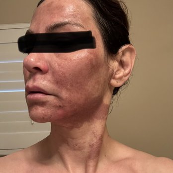Salon Bisou - Discoloration scaring and burn after chemical peel with Suzy Topjian Minassian @suziesbrowglowstudio - Nail Salons Near Me - La Cañada Flintridge, California Salon Bisou - Discoloration scaring and burn after chemical peel with Suzy Topjian Minassian @suziesbrowglowstudio - Nail Salons Near Me - La Cañada Flintridge, California
