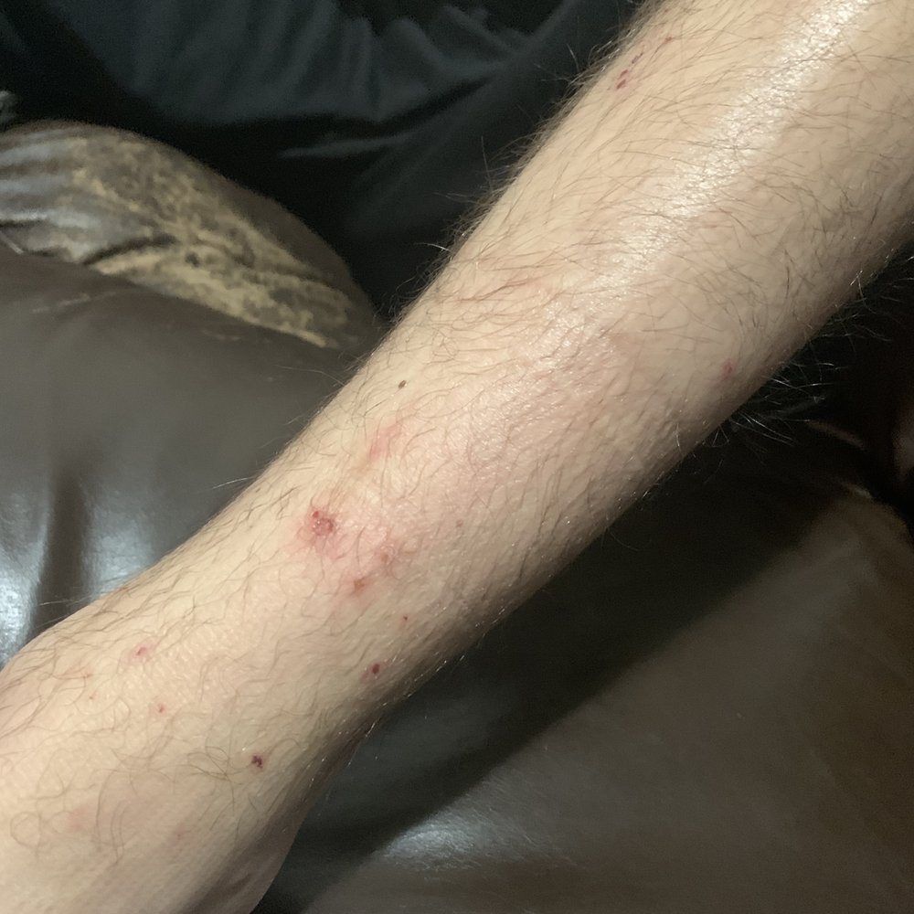 Bradford Real Estate - This is the result of fleas in our apartment. Bradford gave us a lease to an apartment infested with bugs. - Property Management Near Me - Montevallo, Alabama Bradford Real Estate - This is the result of fleas in our apartment. Bradford gave us a lease to an apartment infested with bugs. - Property Management Near Me - Montevallo, Alabama