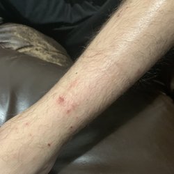 Bradford Real Estate - This is the result of fleas in our apartment. Bradford gave us a lease to an apartment infested with bugs.