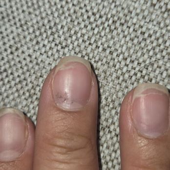 JNP Nail Lounge - Had to cut super low so my skin wouldnt pull off more from the broken nails. - Nail Salons Near Me - Lynnwood, Washington