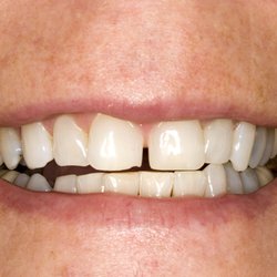 Borowski Cosmetic Dentistry - Before 4 veneers