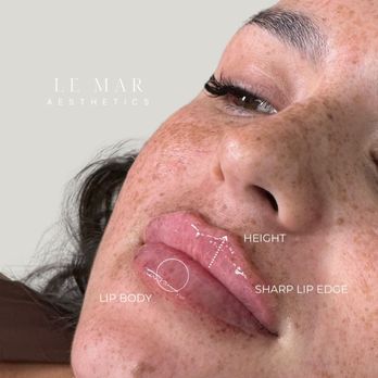 Le Mar Aesthetics - Lip filler - Medical Spas Near Me - Miami, Florida