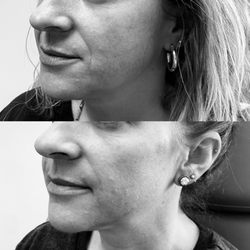 Peaktox - Nasolabial Filler/ Smile Lines