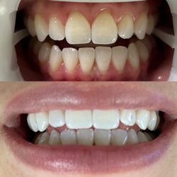Ultra Chic Whitening - Before & After