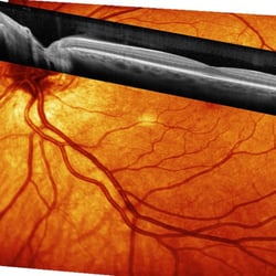 Retina Vitreous Associates of Florida - Optical Coherence Tomography